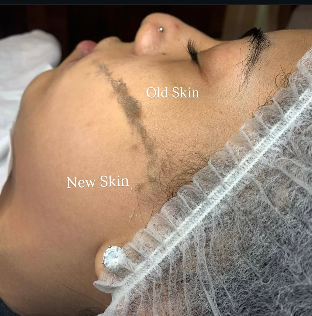 Dermaplaning Masterclass (Deposit)